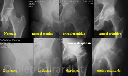 Varie cause possono portare alla degenerazione dell'articolazione dell'anca