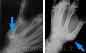 Quadri radiografici di rizoartrosi